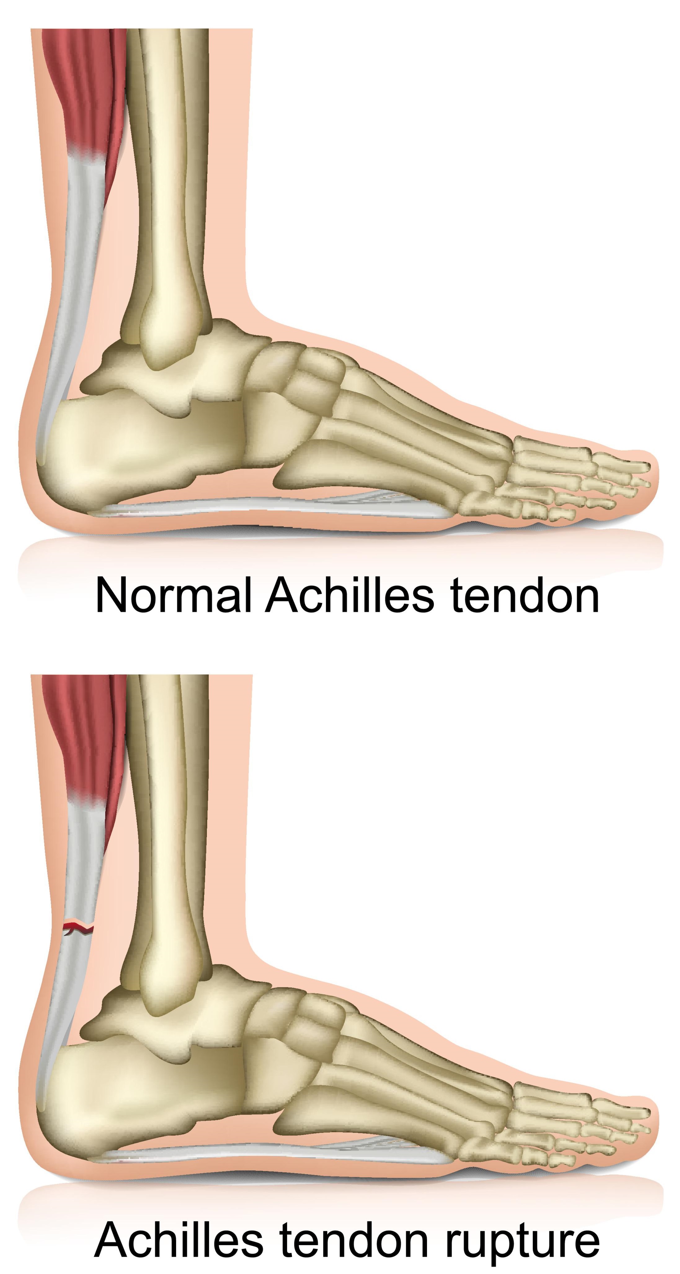 Achilles tendon rupture (tear 