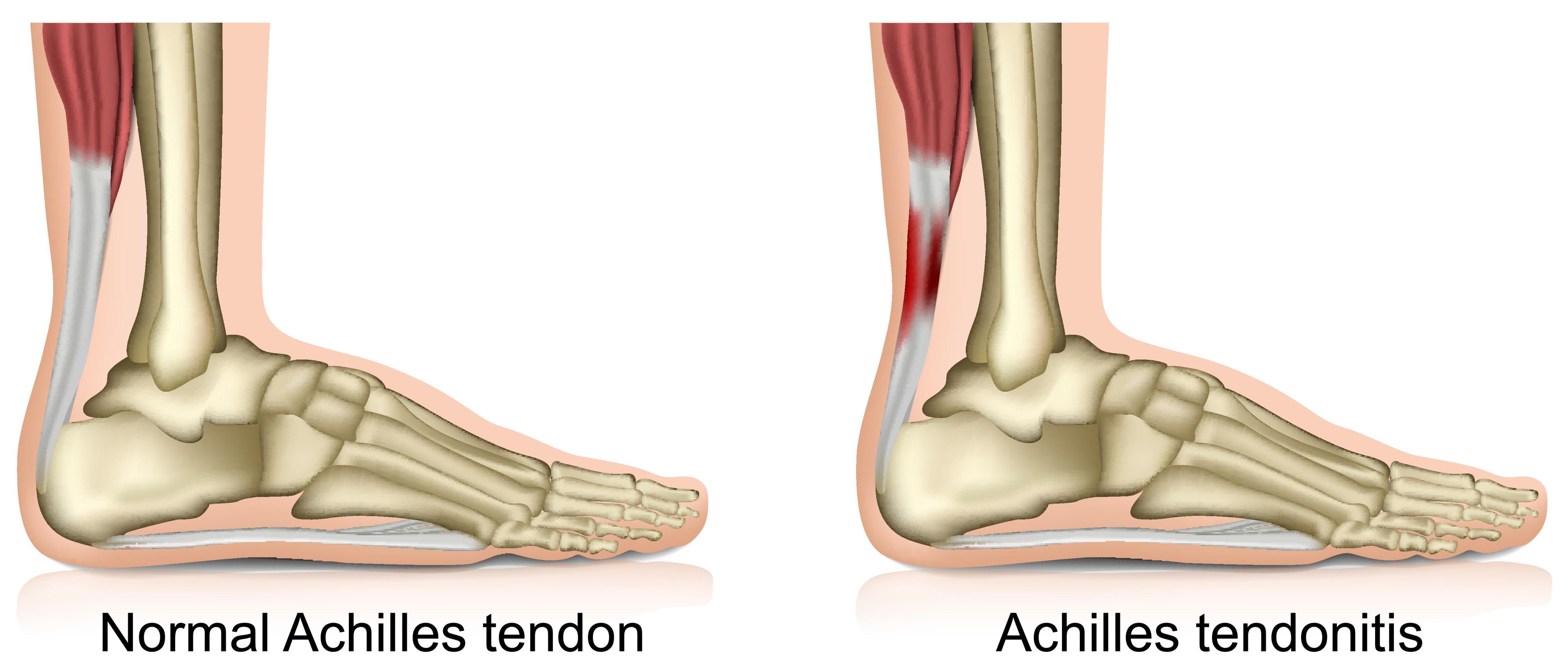 pain in heel below achilles tendon