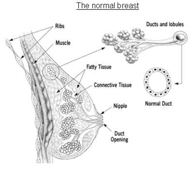 Breast cancer 1