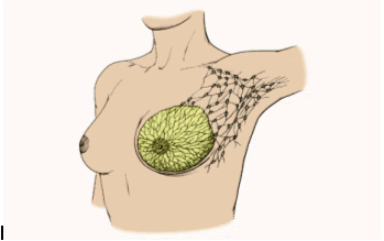 Breast cancer 2
