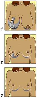Breast reduction 1