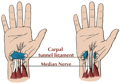 Carpal tunnel syndrome 1
