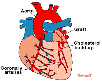 Image result for coronary heart disease diagram