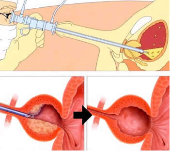 Enlarged prostate 1