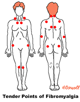 Fibromyalgia 1
