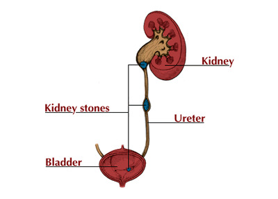 Kidney stones 2