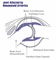 rheumatoid arthritis causes symptoms treatment southern cross nz juvenile rheumatoid arthritis symptom