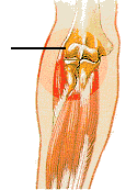 Tennis elbow 1