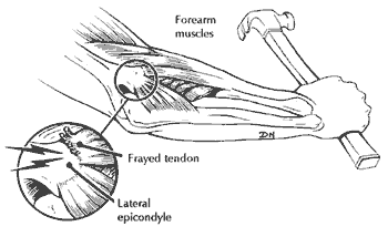 Tennis elbow 2
