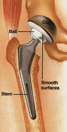 Total hip joint replacement 1