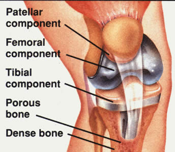 Total knee joint replacement 1