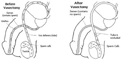 Vascectomy 1